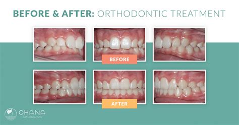 Before-and-after orthodontic treatment visuals